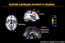 Les zones principales de la douleur